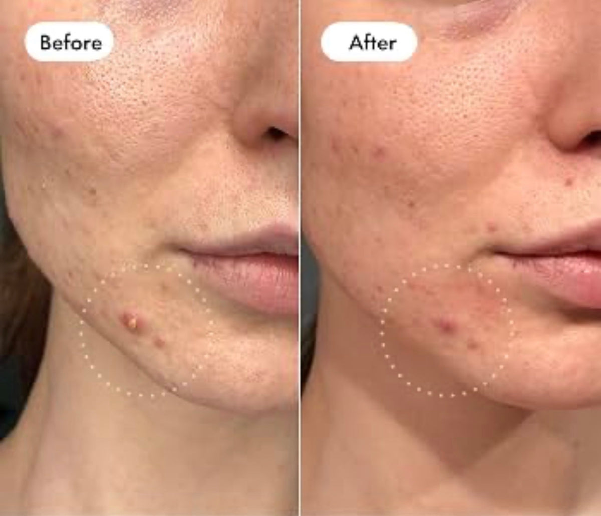 Invisible Hydrocolloid Acne Patch for Facial Repair (One Box)