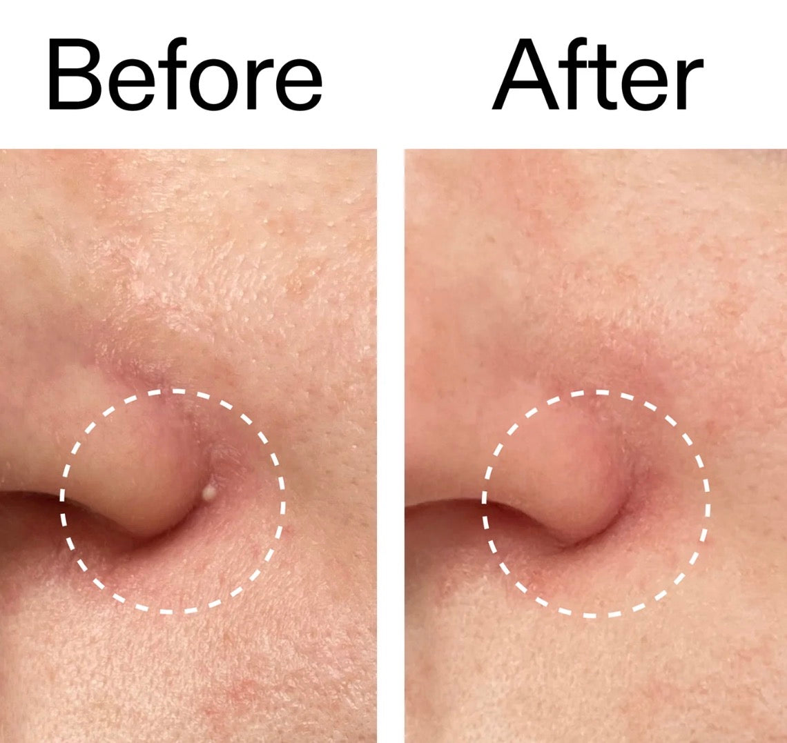 Invisible Hydrocolloid Acne Patch for Facial Repair (One Box)